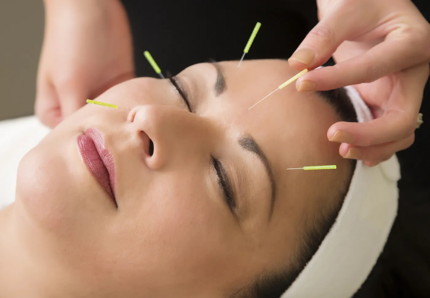 Acupuncture esthétique : fines aiguilles posées sur le visage d'une femme détendue